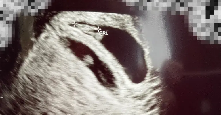 6 Week Ultrasound Twins – What to Expect