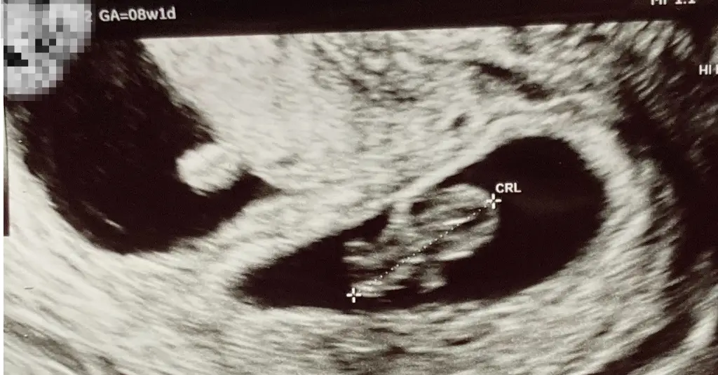 8 week ultrasound twins,
8 weeks pregnant ultrasound twins,
8 weeks pregnant with twins,
twins at 8 weeks gestation,
twins at 8 weeks,
twin ultrasound 8 weeks,
twins at 8 weeks ultrasound,
twin pregnancy 8 weeks