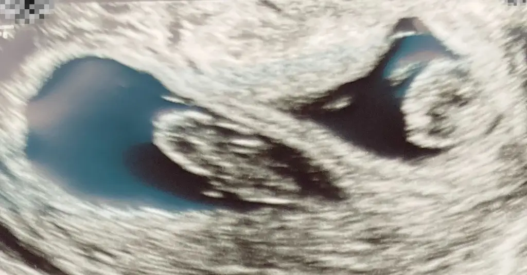 8 week ultrasound twins,
8 weeks pregnant ultrasound twins,
8 weeks pregnant with twins,
twins at 8 weeks gestation,
twins at 8 weeks,
twin ultrasound 8 weeks,
twins at 8 weeks ultrasound,
twin pregnancy 8 weeks