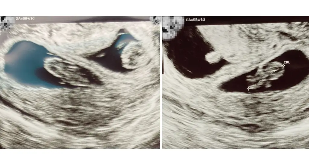 8 week ultrasound twins, 8 weeks pregnant ultrasound twins, 8 weeks pregnant with twins, twins at 8 weeks gestation, twins at 8 weeks, twin ultrasound 8 weeks, twins at 8 weeks ultrasound, twin pregnancy 8 weeks